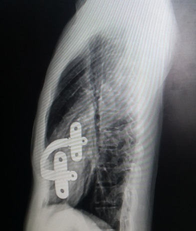 漏斗胸矫正微创手术,最新的漏斗胸微创手术