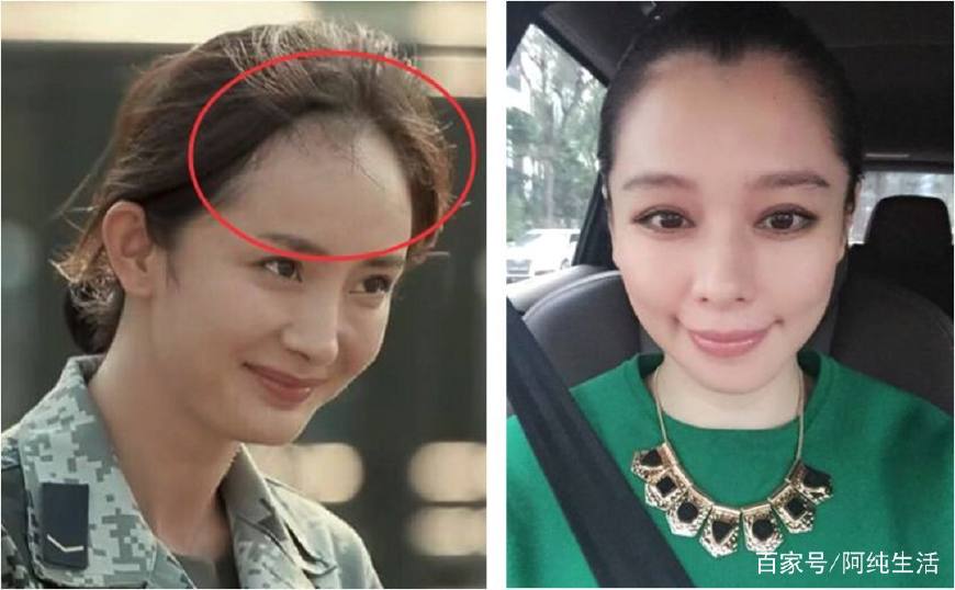 别让秃头误了你的颜值,不要让发际线毁了