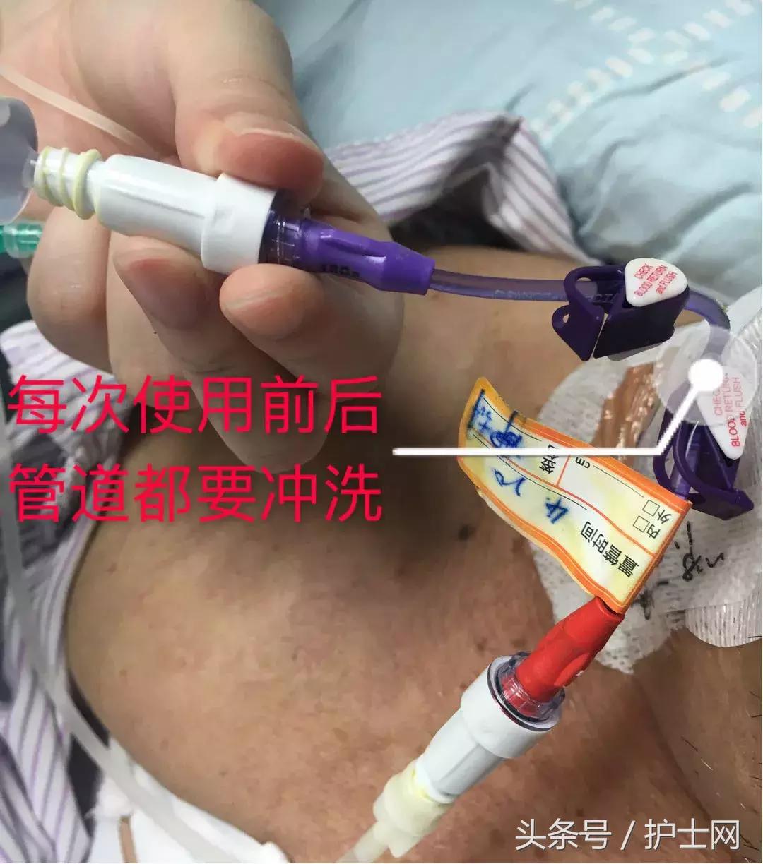 picc置管术在颈部吗,颈部picc管是怎么放进去的