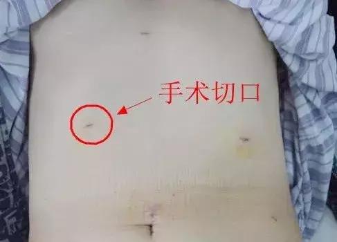 老人肠穿孔保守治疗10天,老人肠梗阻肠穿孔了怎么办