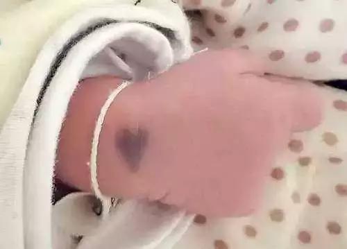 宝宝小屁屁红红的老是哭怎么办,婴儿屁屁发青是怎么回事