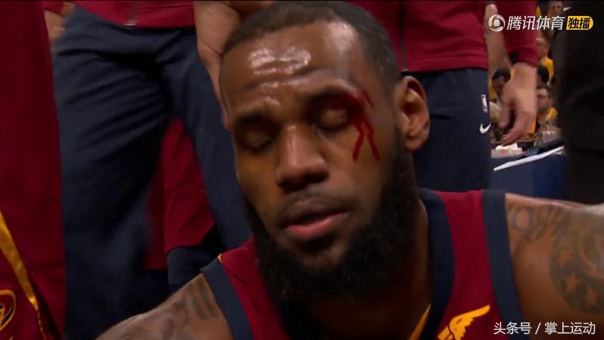 詹姆斯肘击对手致其出血遭驱逐,詹姆斯被肘到眼角出血