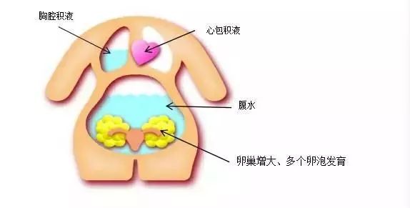 20岁女大学生捐卵事件18年,女大学生捐卵致富