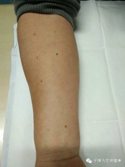 过敏性鼻炎像得了不治之症,过敏性鼻炎是不是什么大病