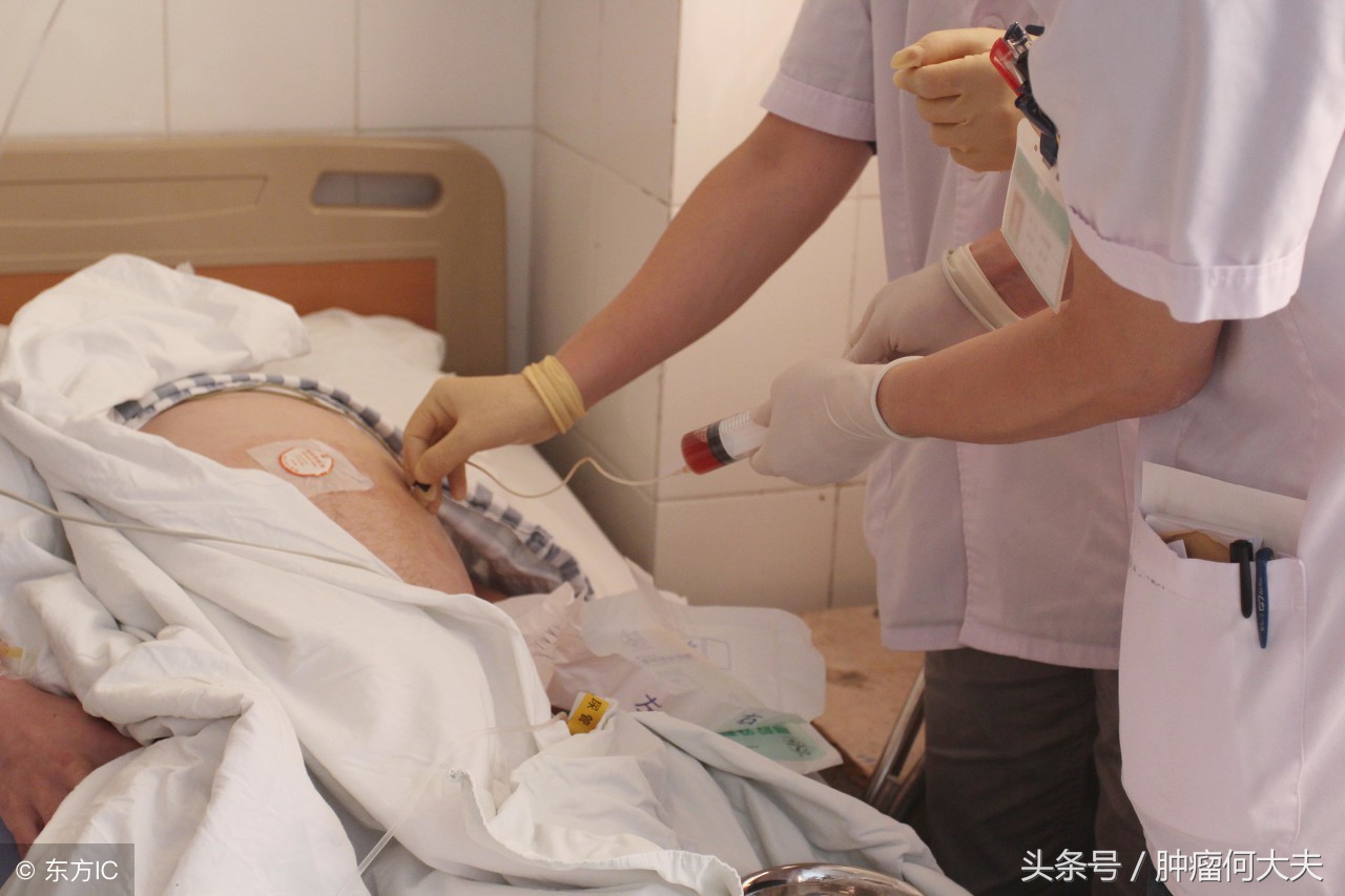 肿瘤腹腔转移有腹水能活多久,癌症晚期腹水腹腔穿刺