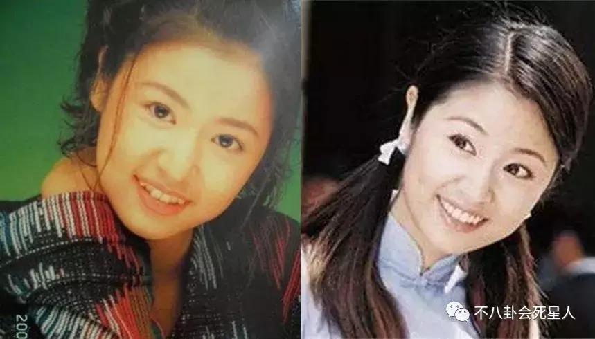 高圆圆戴牙套的脸型变化图,高圆圆戴牙套前后对比照