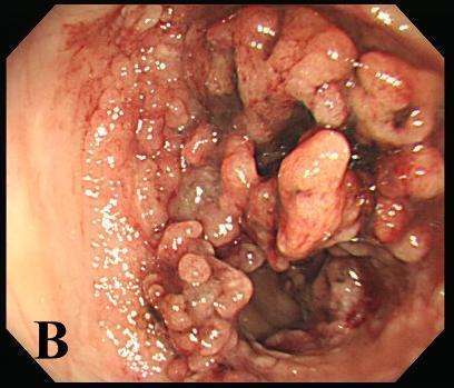 胃肠息肉手术多少钱,胃肠息肉的症状表现