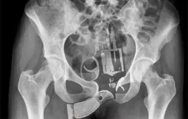 盘点X光透视下的人体异物,看着都痛!