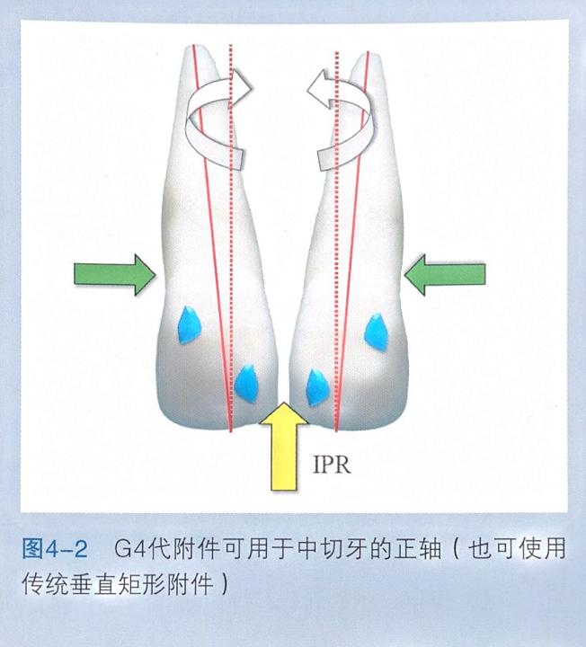 牙齿上的黑三角怎么才能清洗干净,去除牙齿黑三角的神器