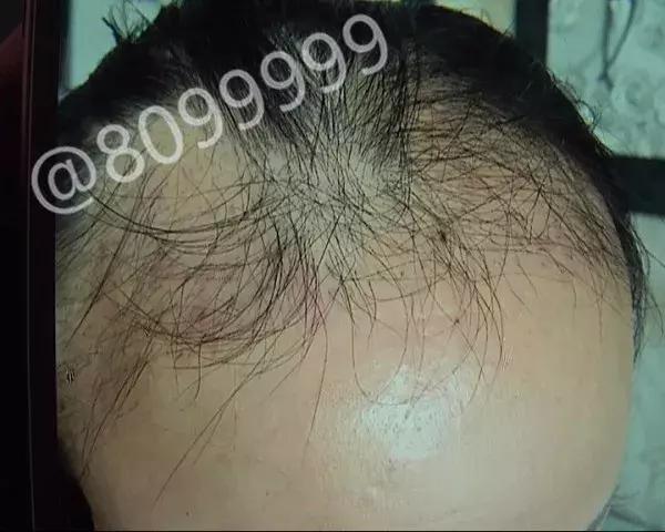 女子植发然后全部脱发,女子斑秃治疗后全秃