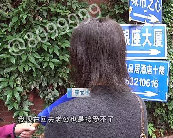 女子植发然后全部脱发,女子斑秃治疗后全秃