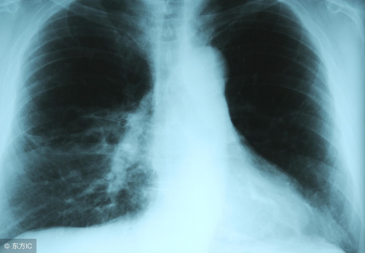 肺炎要注意哪些事项及饮食,肺炎的注意事项