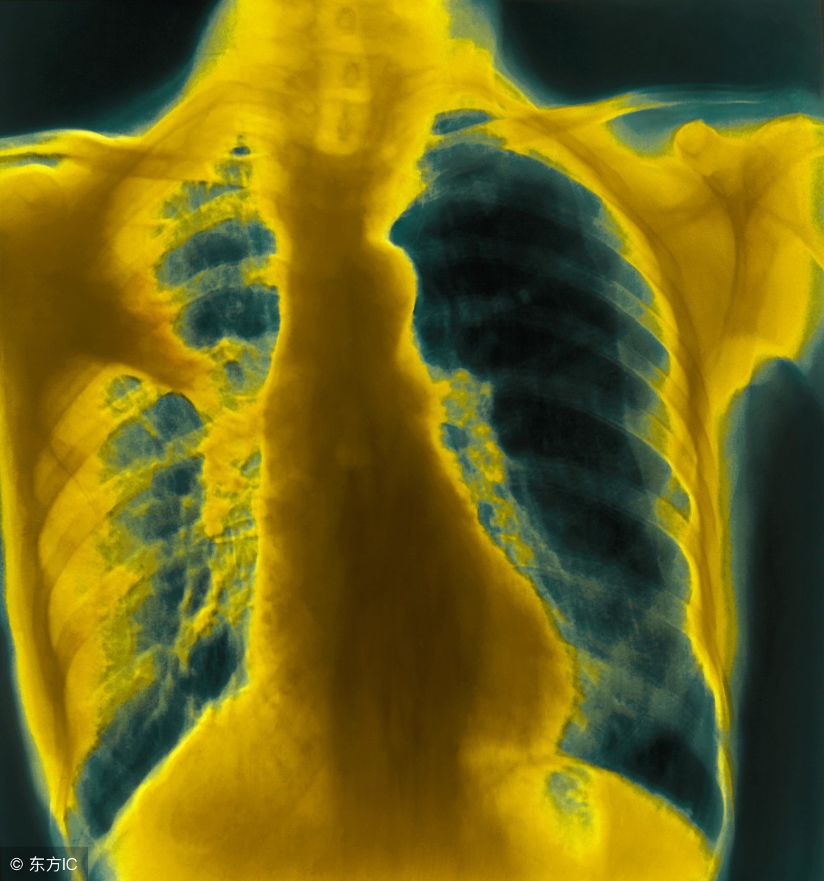 肺炎要注意哪些事项及饮食,肺炎的注意事项