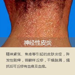 面部脂溢性皮炎是艾滋病吗,面部脂溢性皮炎刺痛怎么办