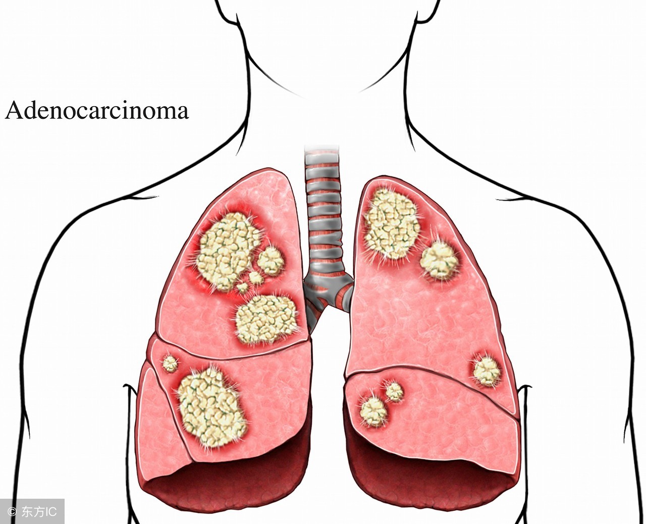 做胸片结果是胸纹理乱,做了胸片肺部上面有肿瘤