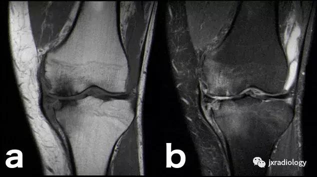膝关节骨髓水肿疼痛特点,膝关节骨髓水肿的临床表现