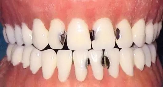 孩子老塞牙怎么办,吃饭塞牙有什么办法解决