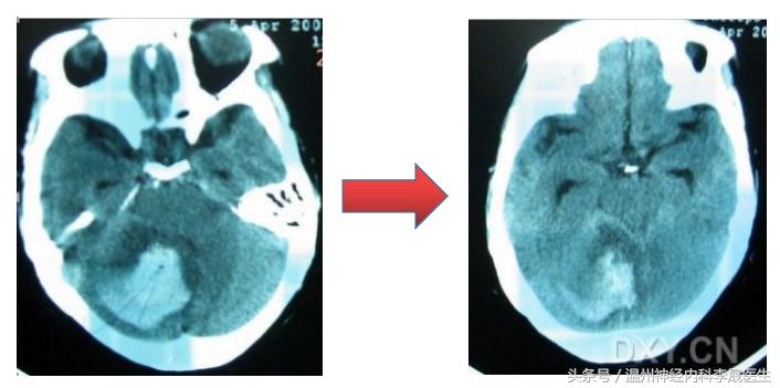 专家讲解中医治疗脑出血视频,医生对脑出血病人的治疗