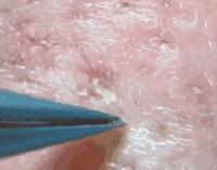 拔黑头和挤痘痘,挤黑头挤痘痘危害