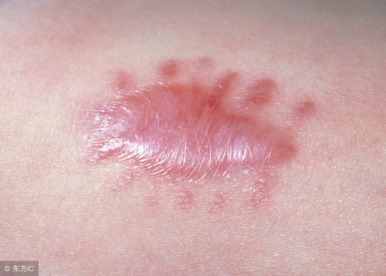 疤痕贴的效果怎么样,疤痕贴有效成分有哪些呢