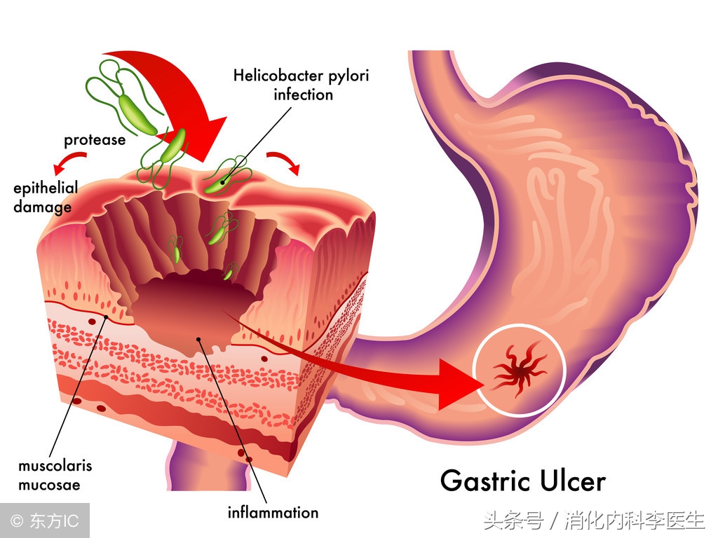 胃溃疡和十二指肠溃疡的主要区别,胃溃疡跟十二指肠溃疡的疼痛区别