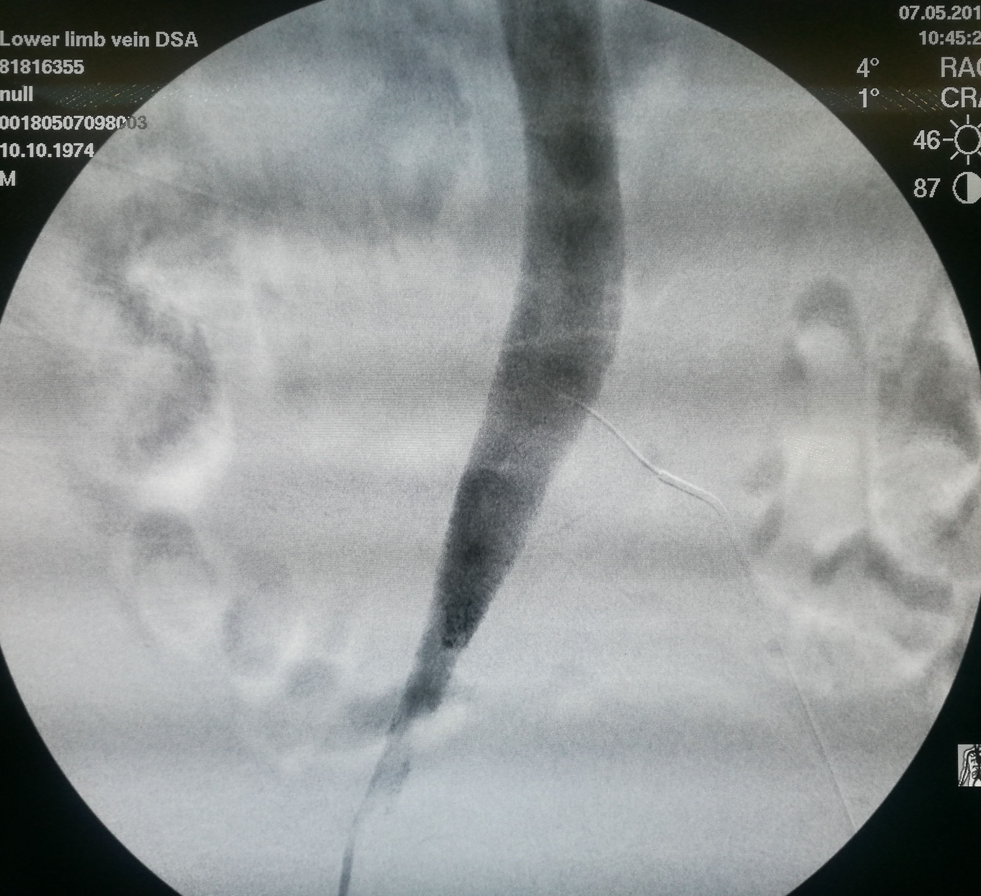 年纪轻轻怎么会一条腿反复血栓,年龄大了得了腿血栓怎么办