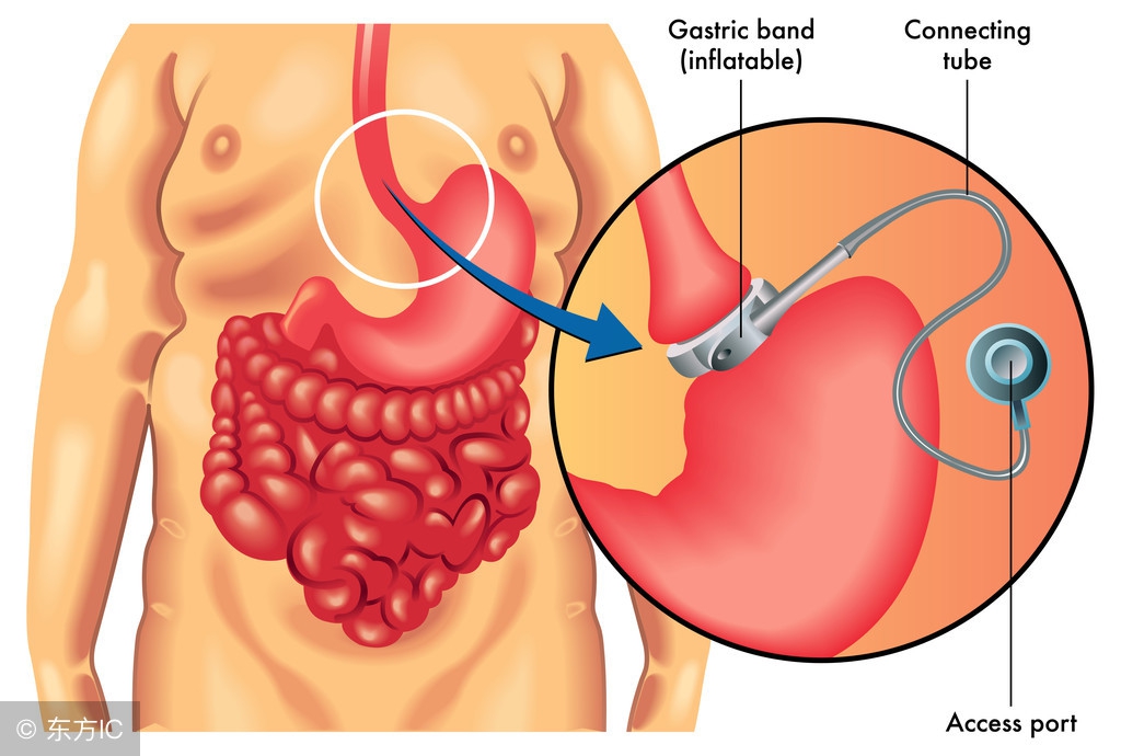 呕血预后,贲门癌呕血有多严重