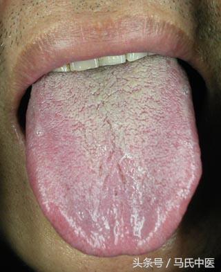 阴寒凝滞的舌象,舌象发暗是怎么回事