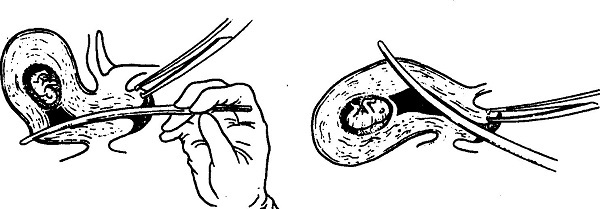 疤痕子宫可以生三胎剖宫产吗,一次剖宫产永远剖宫产吗