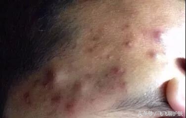 大概只有自己最清楚为什么长痘,各种痘痘类型都是如何产生的