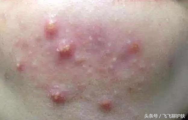 大概只有自己最清楚为什么长痘,各种痘痘类型都是如何产生的