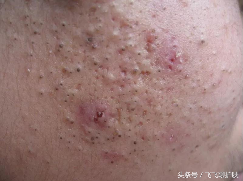 大概只有自己最清楚为什么长痘,各种痘痘类型都是如何产生的