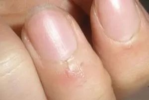 怎么从指甲上看健康图解,从指甲看疾病的图片说明