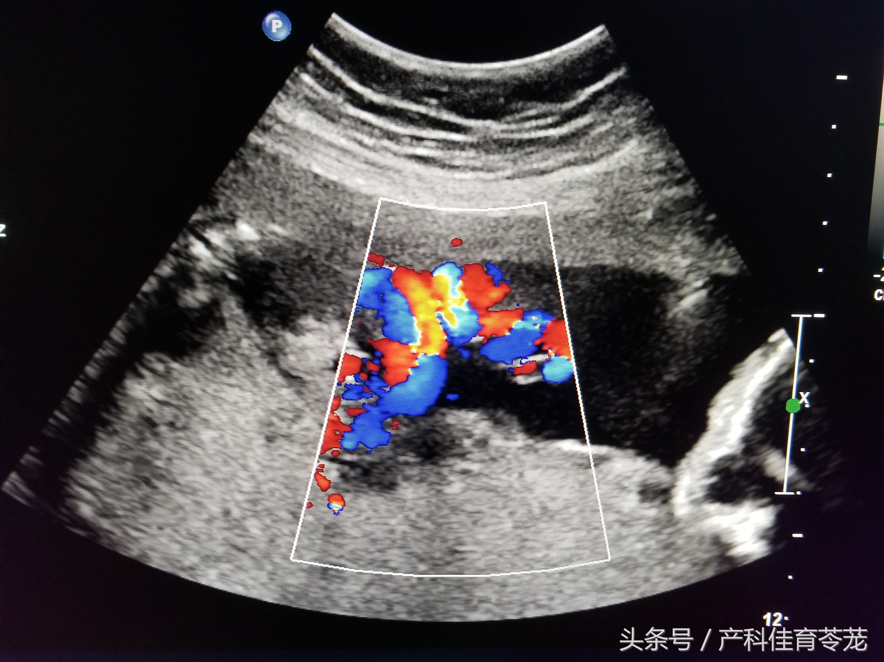 产科彩超报告解读,教您看懂产科超声报告