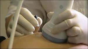 怀孕前期唐氏筛查结果,唐氏筛查结果怎么看的