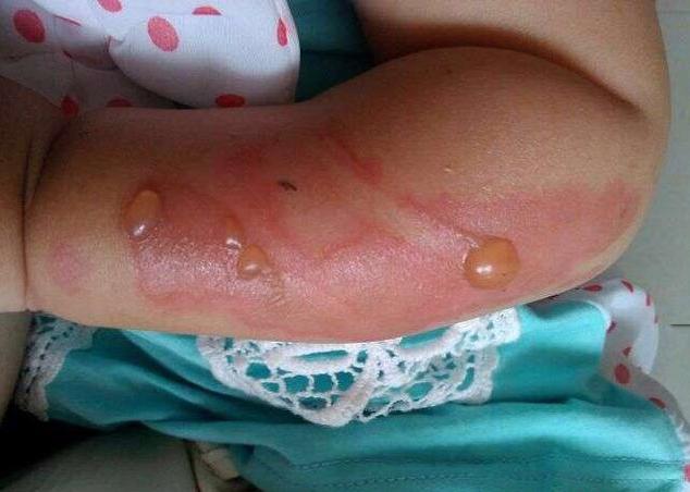 一岁小孩二级烫伤会怎么样,宝宝二级烫伤多久可以恢复到正常