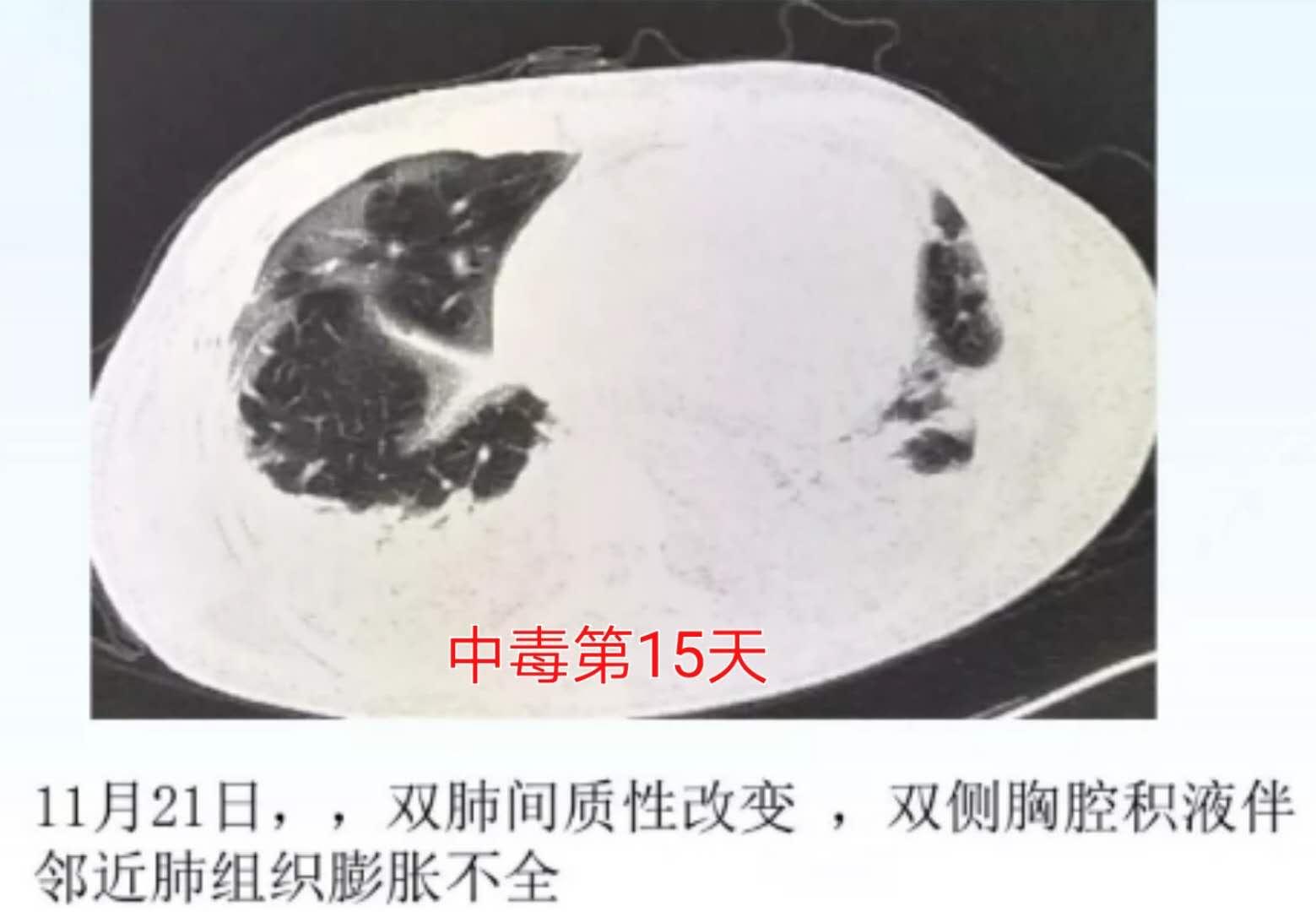 百草枯中毒救活成功率,百草枯中毒能救活吗