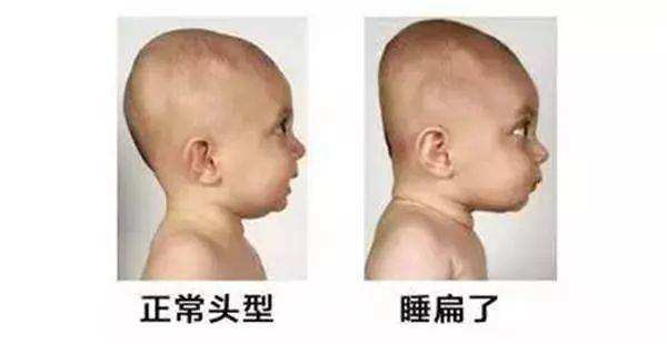 宝宝后脑勺睡平了有什么危害,一岁半宝宝后脑勺突出还能睡平吗
