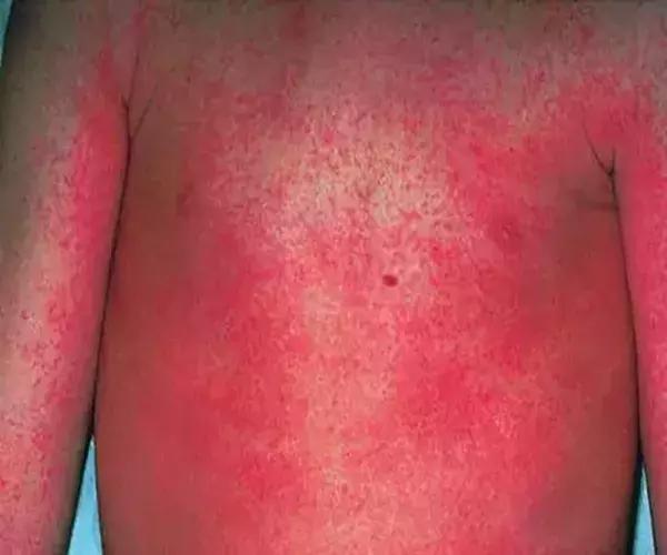 夏季猩红热高发家有娃娃要当心,为什么猩红热高发于儿童