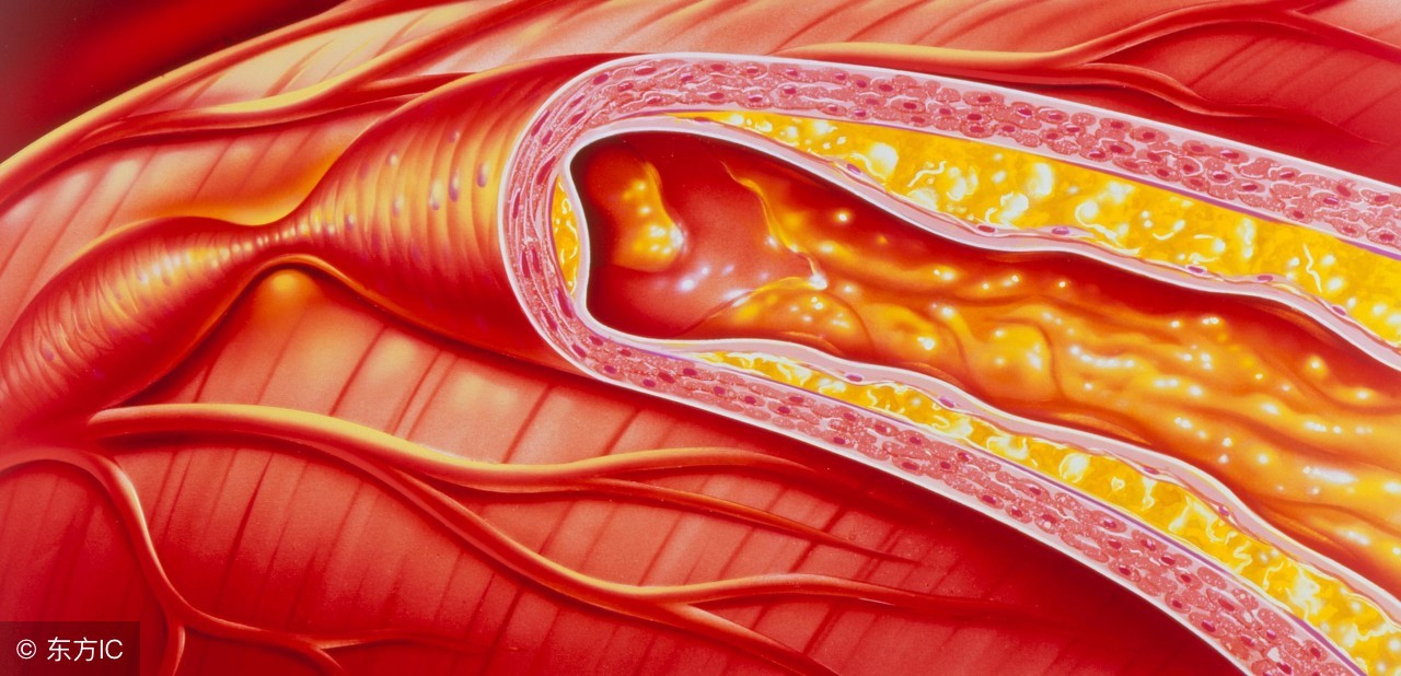 治疗高胆固醇血症应首选的药物是,简述高胆固醇血症的发病机制
