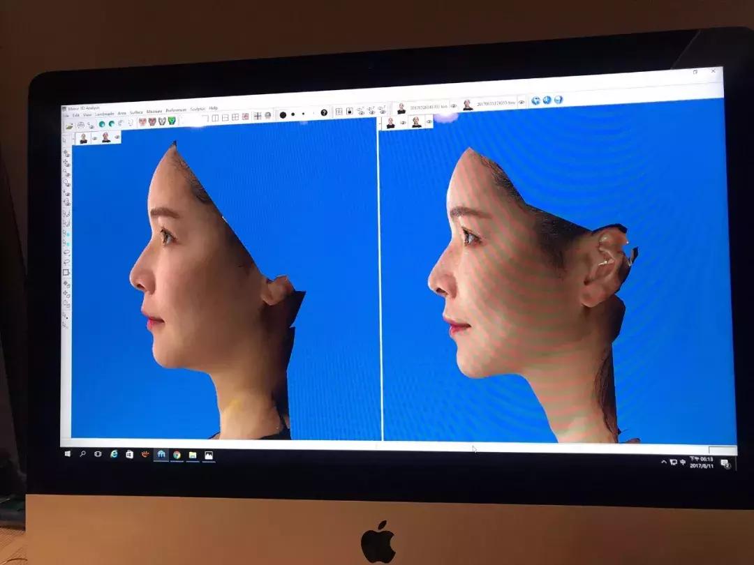 几千块钱做的超声刀，想要逆龄反被毁容？！