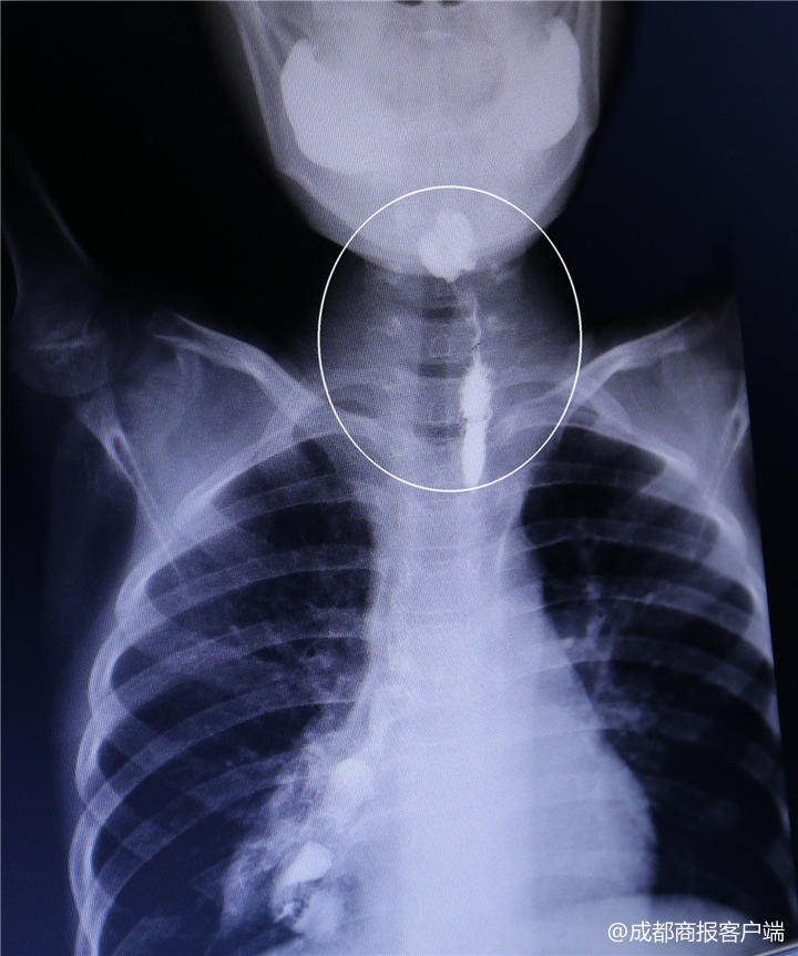 误食强碱灼伤食道后续,误食强碱灼伤食道的后果