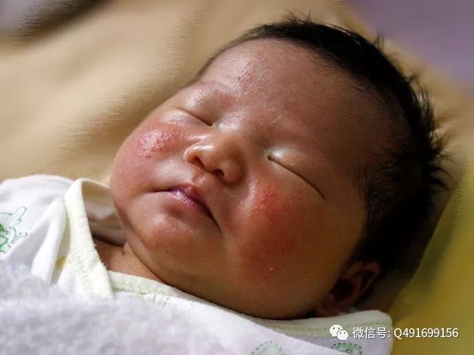 新生儿常见的生理反射有哪些,新生儿特殊生理现象照片