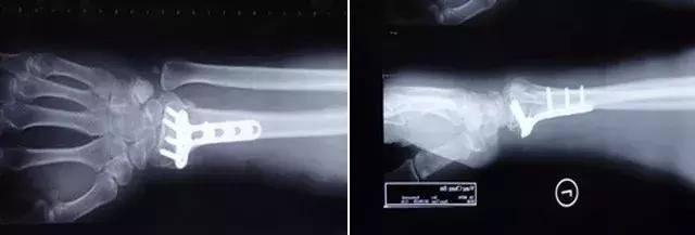 骨折复位后再次移位是什么原因,儿童尺桡骨骨折复位后轻微移位