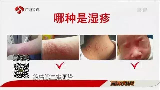 湿疹痱子怎么治疗最好最快最有效,如何正确判断湿疹与痱子