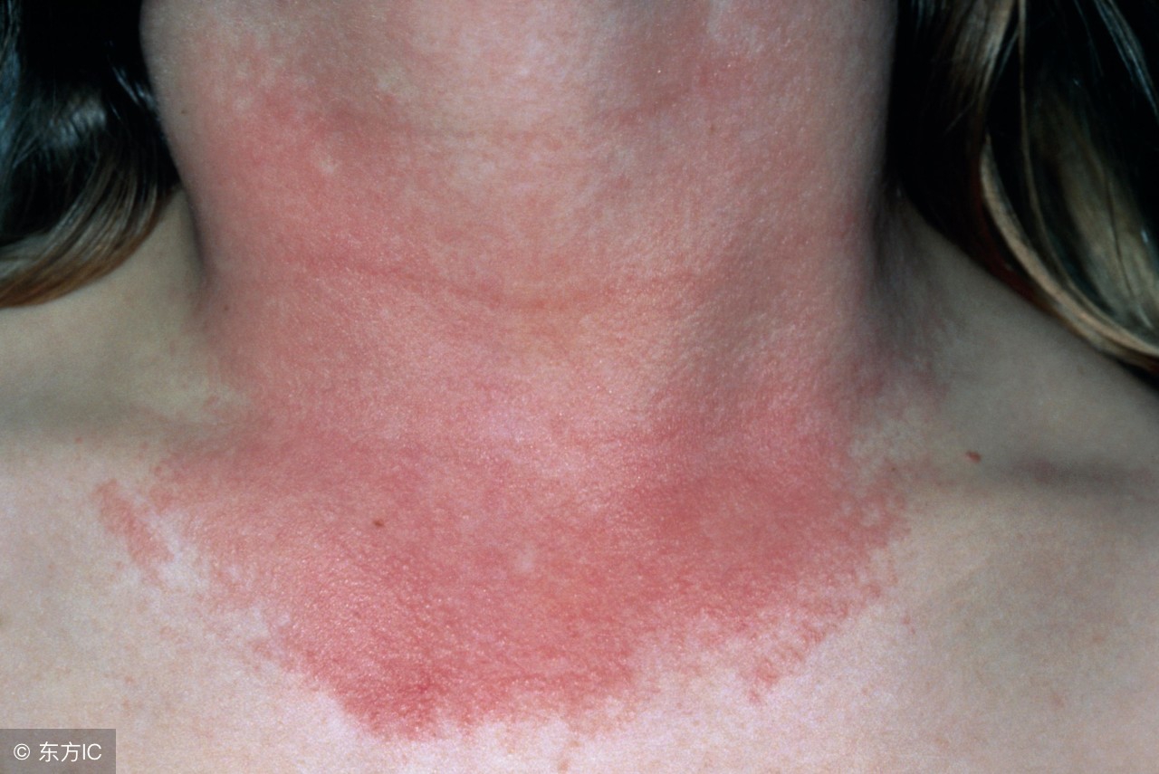 神经性皮炎的防治都有啥