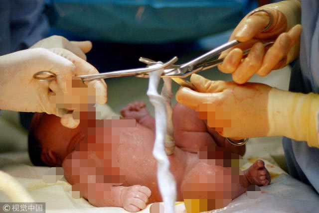 医生剪断脐带,新生儿剪断脐带