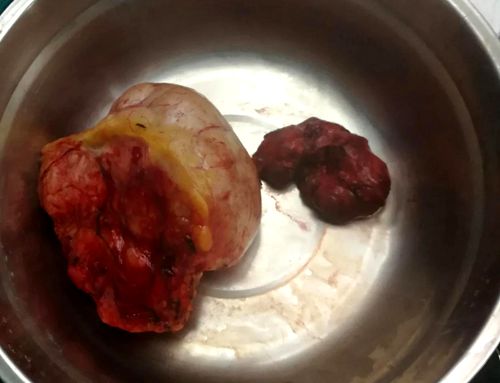 纵隔肿瘤切除后注意事项,纵隔肿瘤较大适合微创吗