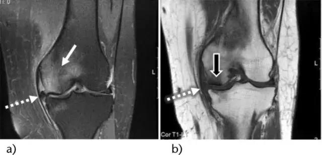 多数跑步伤痛正确处理都会痊愈，超过3个月仍然困扰你就要警惕了
