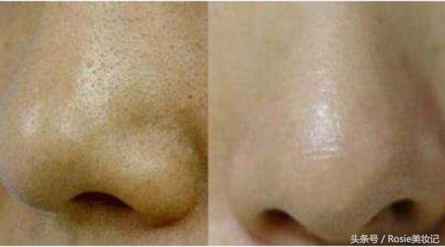 消灭闭口粉刺,脸上长了闭口粉刺怎么解决